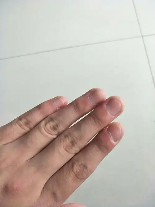 小时候咬指甲厉害.现在指甲成这样了.现在好自卑.