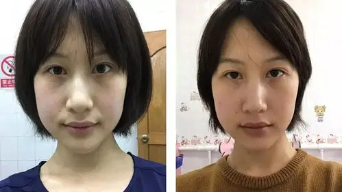 素人整形分析 | 长中庭 长脸的成熟脸,如何开启变美大门