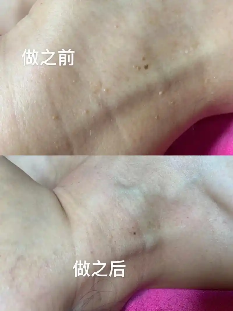 皮肤管理中心 疣的起因:是因为hpv病毒,还有自身免疫力低 - 抖音