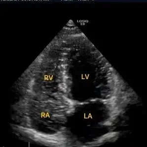 头痛查心找病因——我院成功开展多例右心声学造影