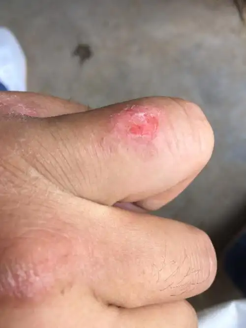 请问医生 手上一直起肉刺.硬皮 好多年了 谢谢