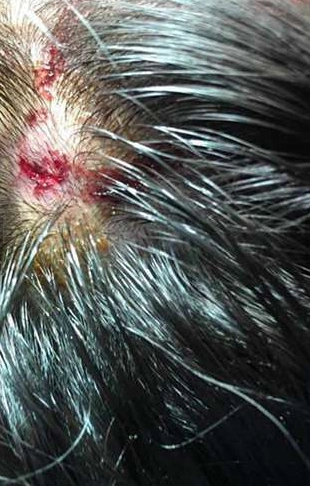 武大校花拍戏被砸 黄灿灿头部伤口清晰可见