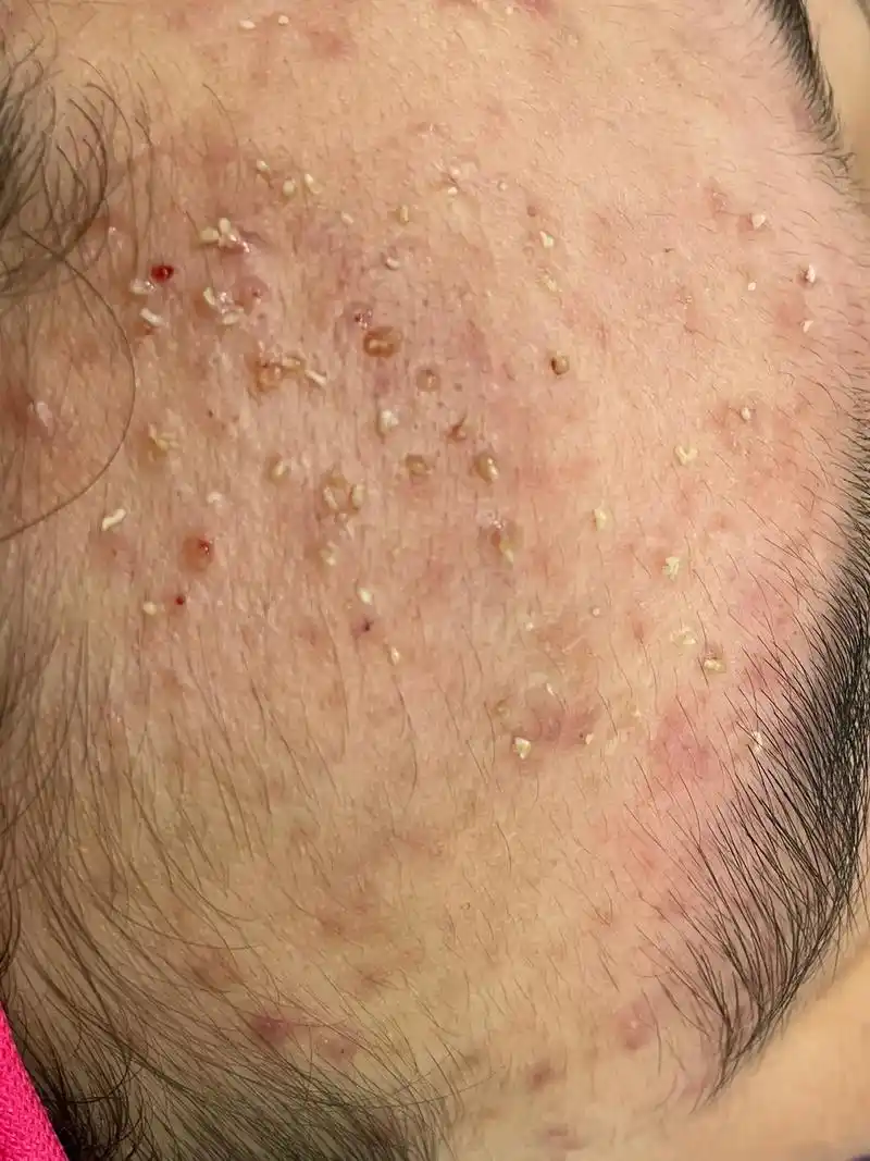 给小朋友治疗痘痘, #解决任何皮肤问题 #痘痘黑头粉刺拜拜  - 抖音