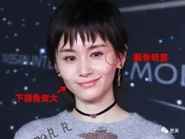 脸上的肉少了,相应地,就会显得颧骨外凸,下颌角肥大