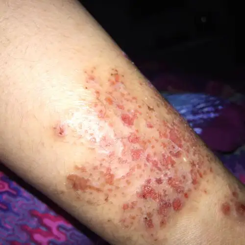 腿上被蚊子咬后抓烂了