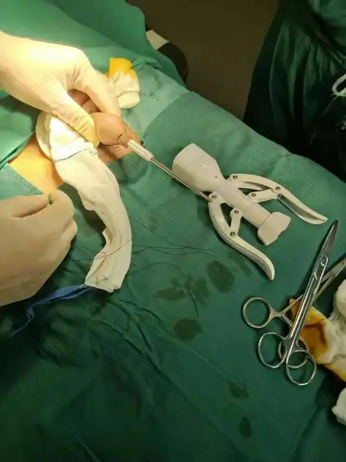 定南中医院为男性朋友解除烦恼,包皮手术只要5分钟,无出血无副作用