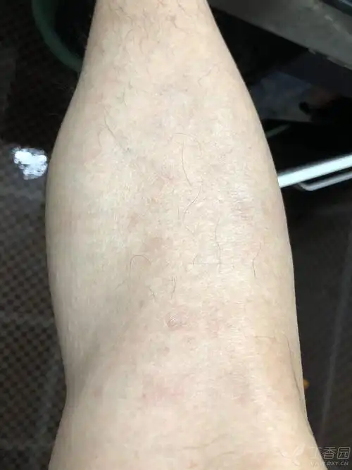 看图诊病 不痛不痒皮疹? - 皮肤及性传播疾病讨论版 - 爱爱医医学论坛