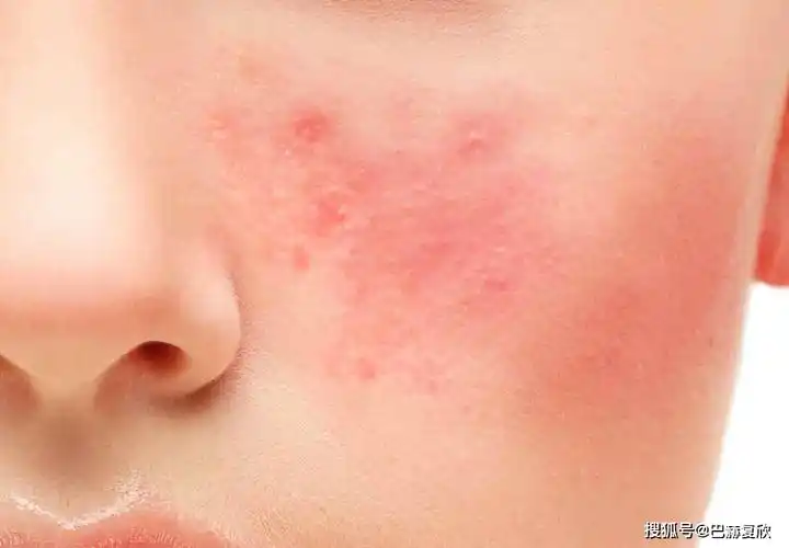 激素脸老不好,到底是哪出了问题?