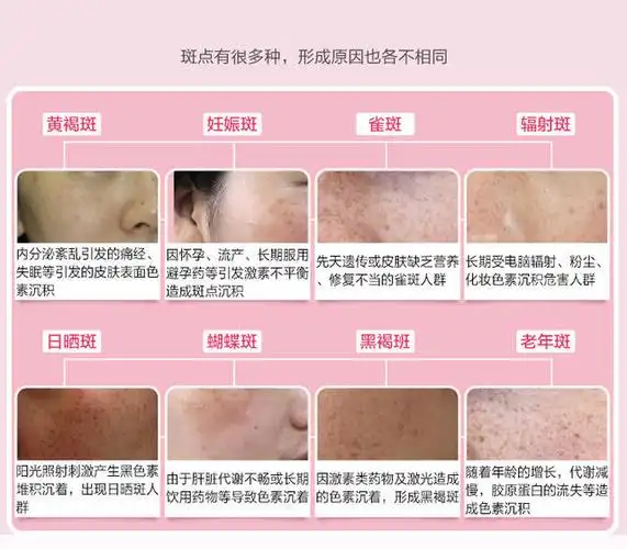 夏天到了,脸上各种斑点都会加深的,比较常见的斑点有