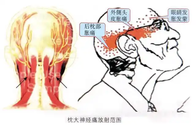 骨科最常见的头晕枕大神经性头晕