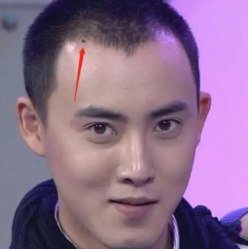 男人发际线上有痣代表什么性格沉稳感情却比较曲折