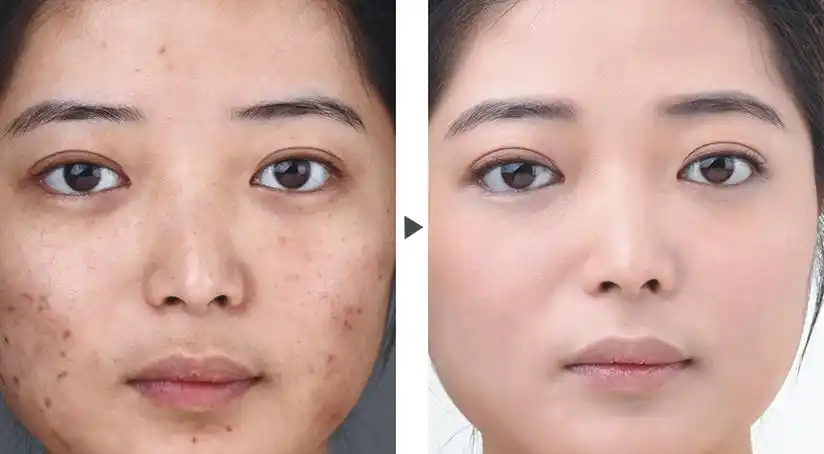 美莱医学祛痘案例对比图,美莱让你和痘痘说再见