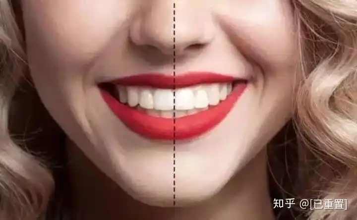 3招教你判断牙齿要不要矫正