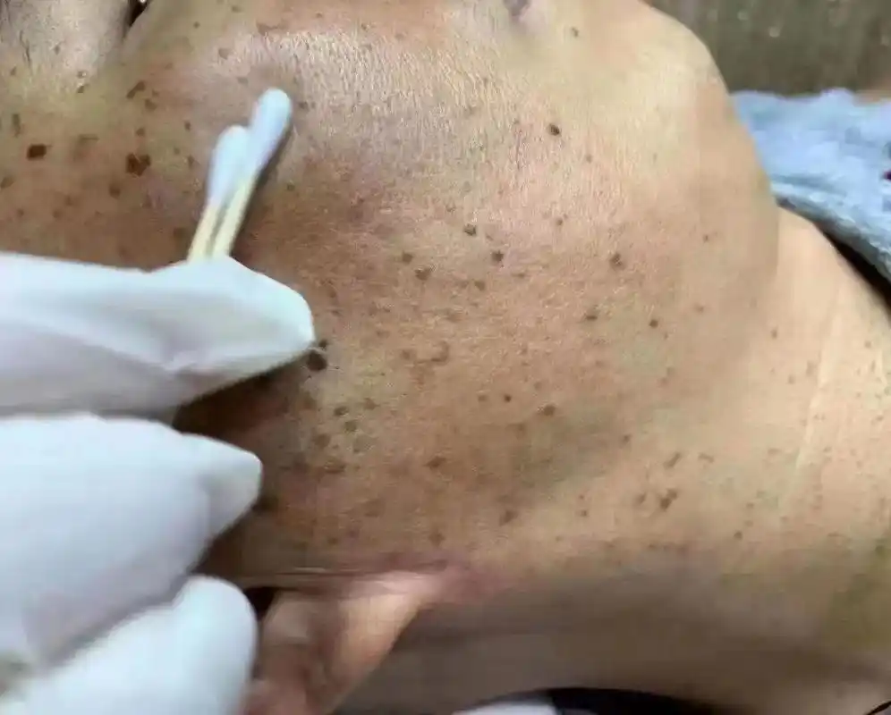 79 21566【扁平疣】73 扁平疣的起因: 是因为hpv病毒,还 - 抖