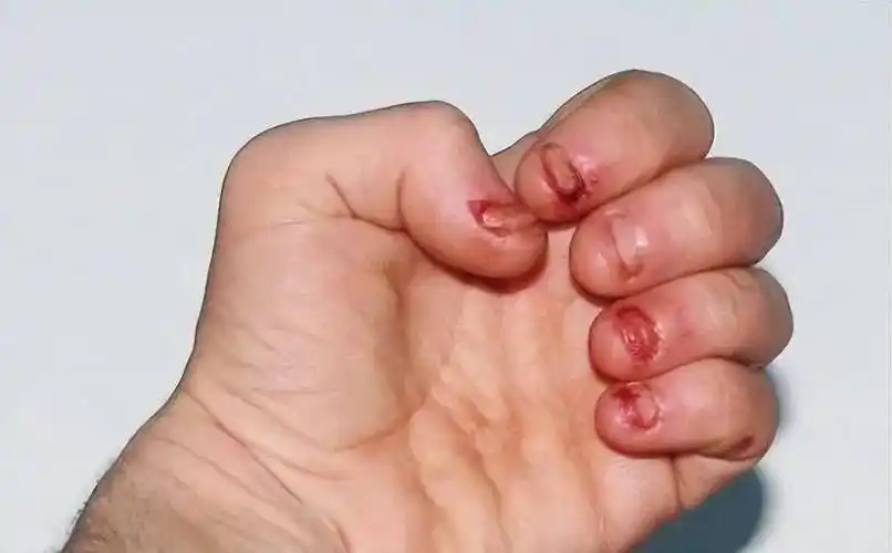 wenno:从小"咬指甲"的孩子,长大后怎么样了?