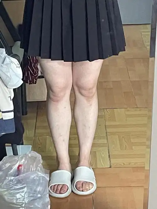 我的膝盖是分层了吗