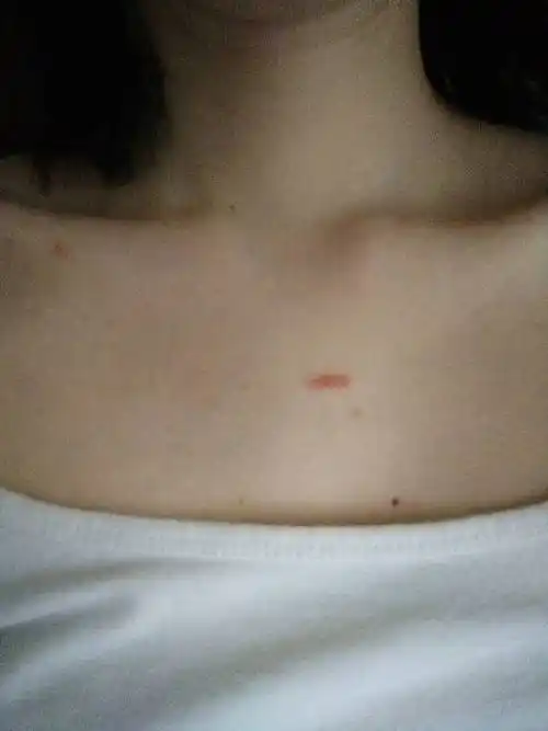 求助,胸前这个红疙瘩是什么?不痛不痒