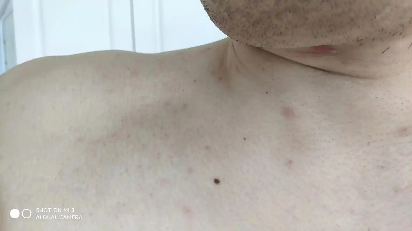 这到底什么玩意,胸前的红点,出汗就冒出来,洗个澡过一会就没了 - 抖音