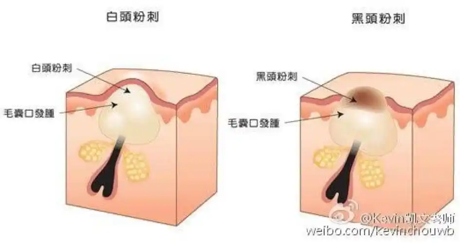 粉刺分为白头和黑头粉刺.