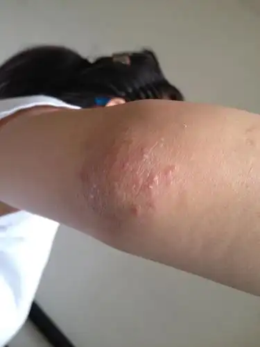 开始面积很小,现在扩大了.怎么根治?o(∩_∩)o谢谢