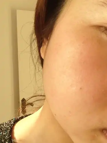 想知道我现在脸部是出的毛孔还是皮肤干燥起的皮啊,本人过敏后已经一