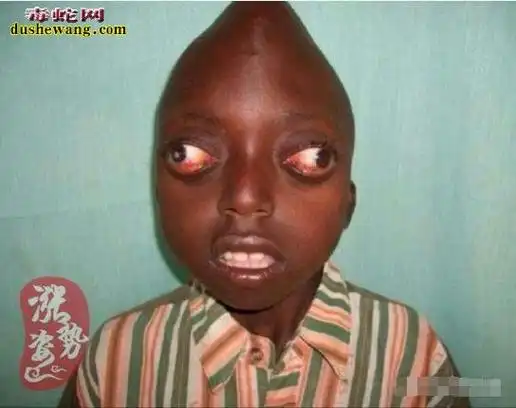 世界上最恐怖的10种人全球十大恐怖畸形人真实图片