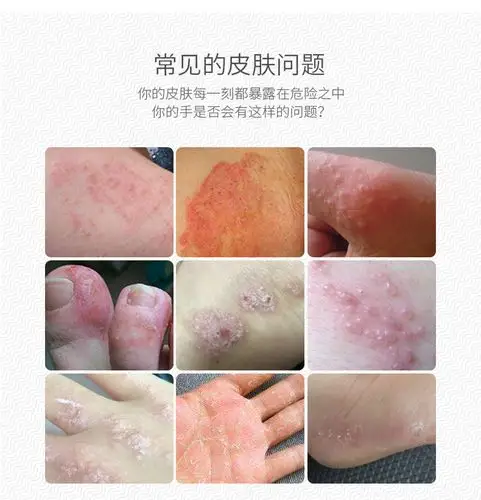 湿疹止痒成人股藓股癣膏大腿内侧牛皮癣药膏霜外用皮肤汗疱疹去根_找