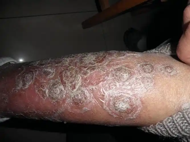 系列皮肤病蛎壳状银屑病