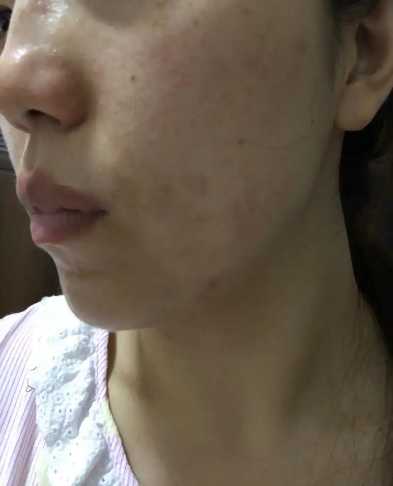 过敏性皮肤,脂溢性皮炎,已经用薇诺娜生物膜一个月了,之前一个月的