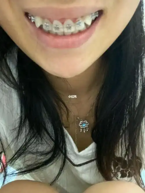 戴牙套的第49天,变化很大,不过现在上牙包下牙比较严重,比没戴之前