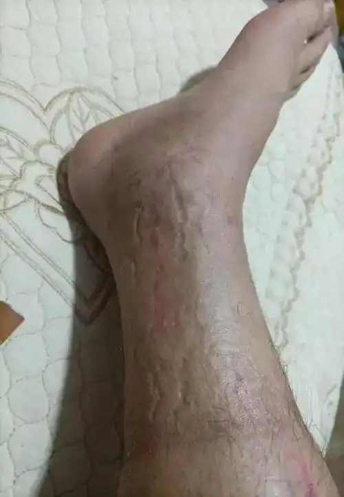 医院故事工地受伤险截肢9个诊断多次手术保腿成功