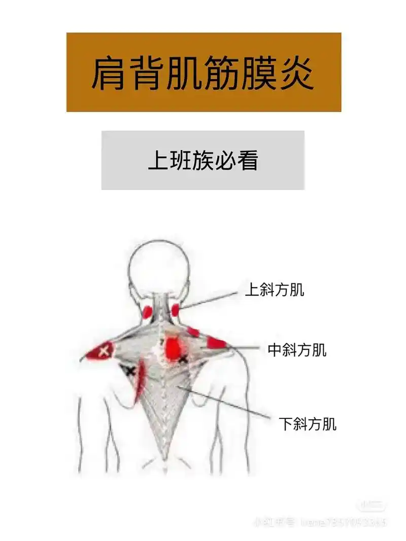 改善日常的姿势,缓解筋膜痉挛,预防颈肩背疼痛 - 抖音