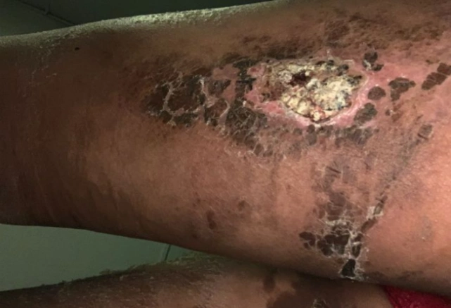 吸脂手术除了凹凸不平以外还有哪些危害?