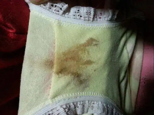 血性白带图片 (43)_有来医生