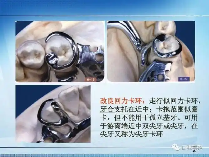 可摘局部义齿卡环的种类