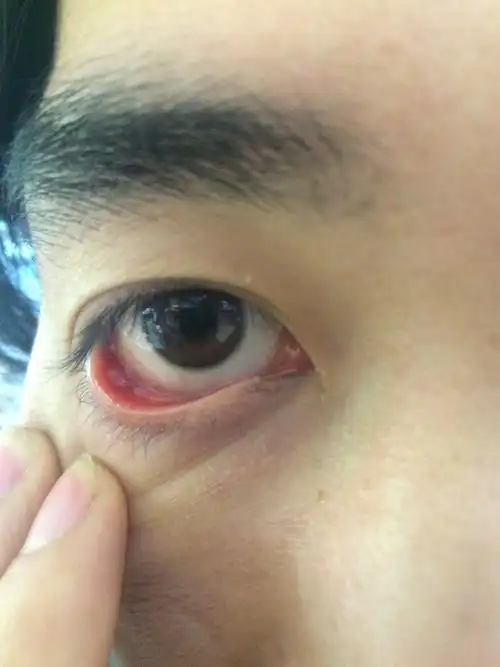眼睛的下眼皮里面长了一个红疙瘩,两只眼睛都有,而且都是在同一个位置