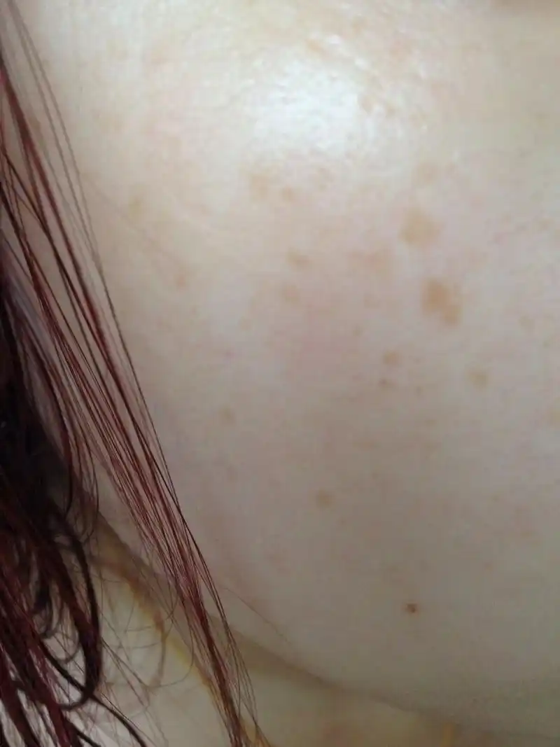 女朋友脸上长斑,有谁遇到这种情况.她正苦恼着用哪一种祛斑产品.