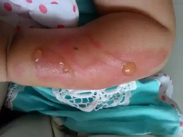 孩子被烫伤后家长应该立刻帮孩子冲洗创面而非找酱油牙膏