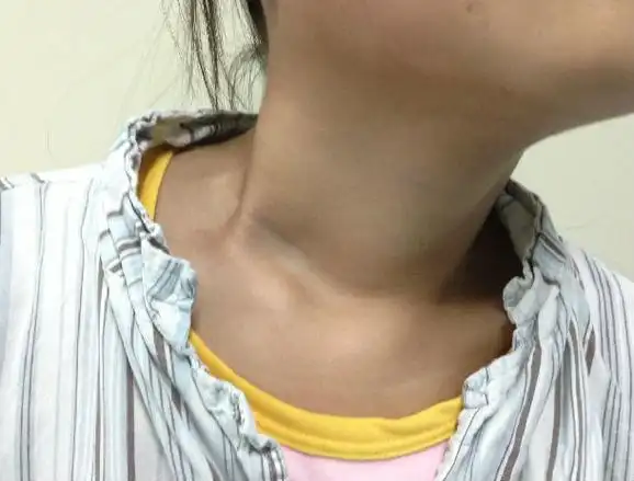 关节镜下微创美容松解先天性肌性斜颈治疗"歪脖子"