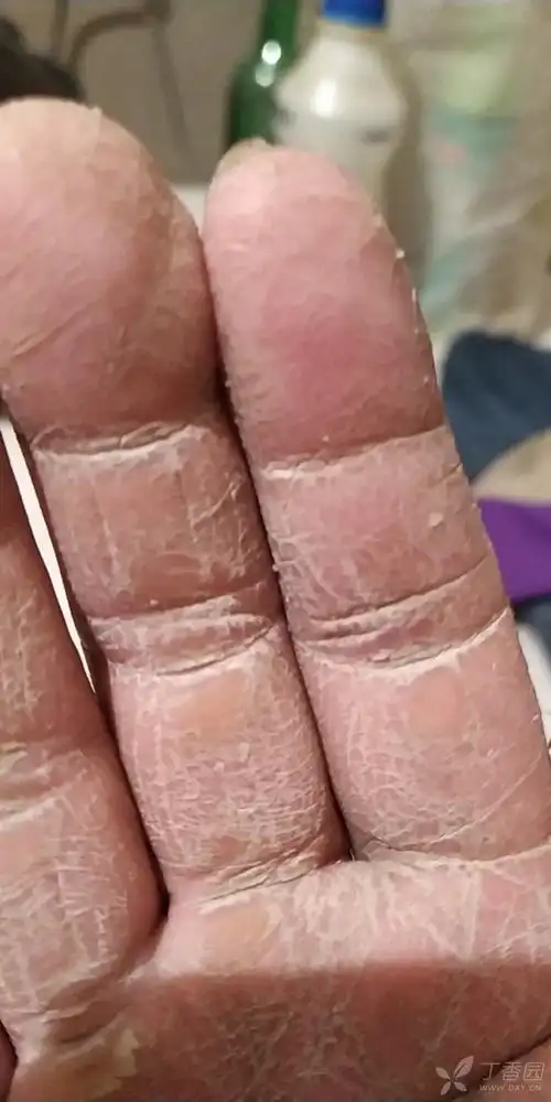 皮肤过度角化 - 皮肤与性传播疾病讨论版 -丁香园论坛