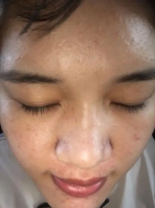 这是毛孔堵塞吗?