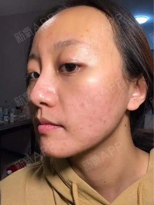 做完果酸焕肤的第6天