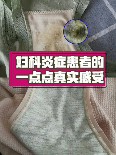 妇科炎症患者的真实感受