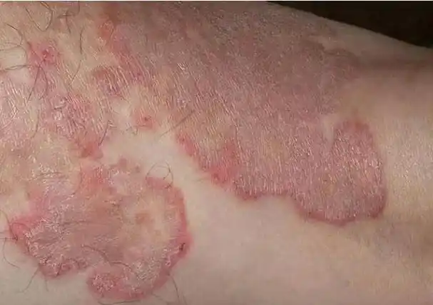 治体股癣这些药物可以选