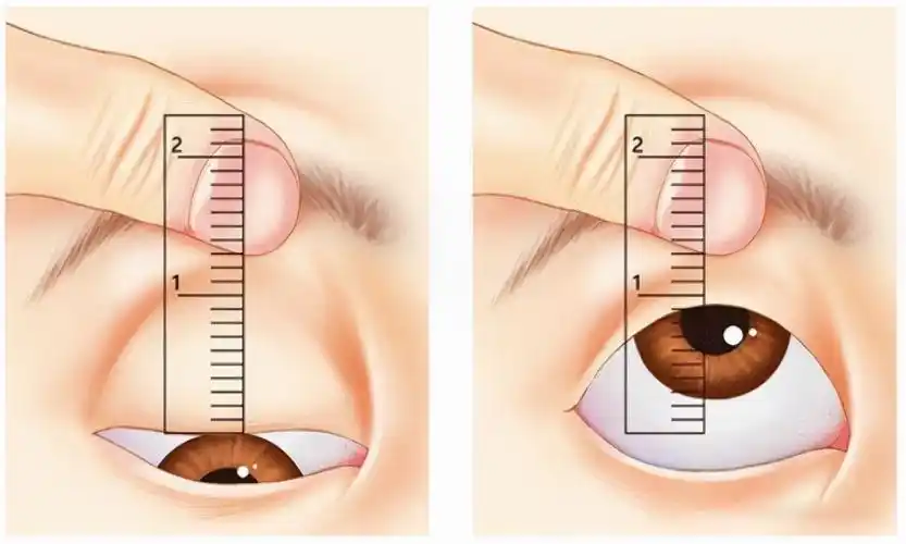 右眼睑下垂手术多少钱(做上睑下垂矫正手术是一种什么体验呢) - 深圳