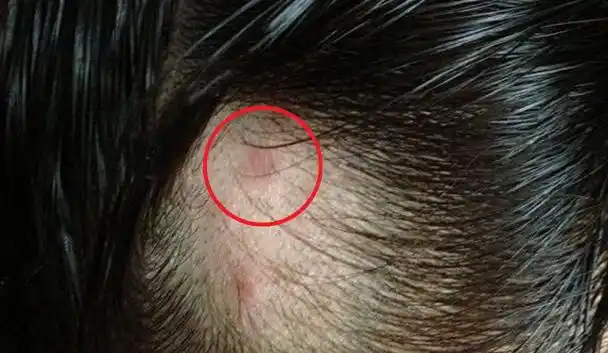 头发有螨虫怎么去除(头皮如何除螨)