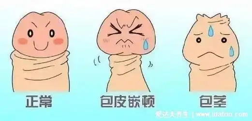包茎手术20天恢复图片,男生割包茎会变大吗(注意x生活需一个月后)