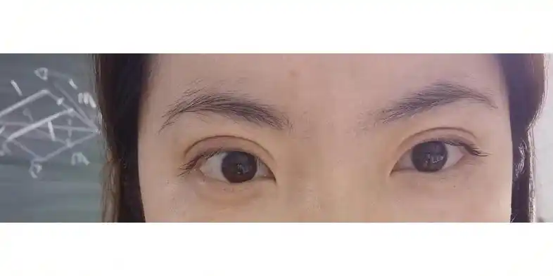 全切双眼皮一年半