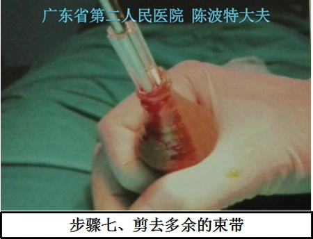 图解一次性包皮环切缝合器手术过程 - 好大夫在线