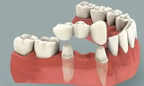 种植牙好不好_种植牙的弊端_半口种植牙好不好_老人做种植牙好不好_种